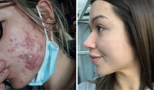 South moon™ 🧴, spray avanzado para cicatrices.