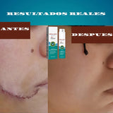 SOUTH MOON-SPRAY PARA CICATRICES